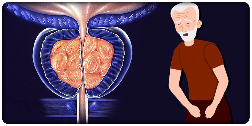 BORITE SE S NEUGODOM PROSTATE? Pogledajte Kako Muškarci Poput Vas Pronalaze Olakšanje